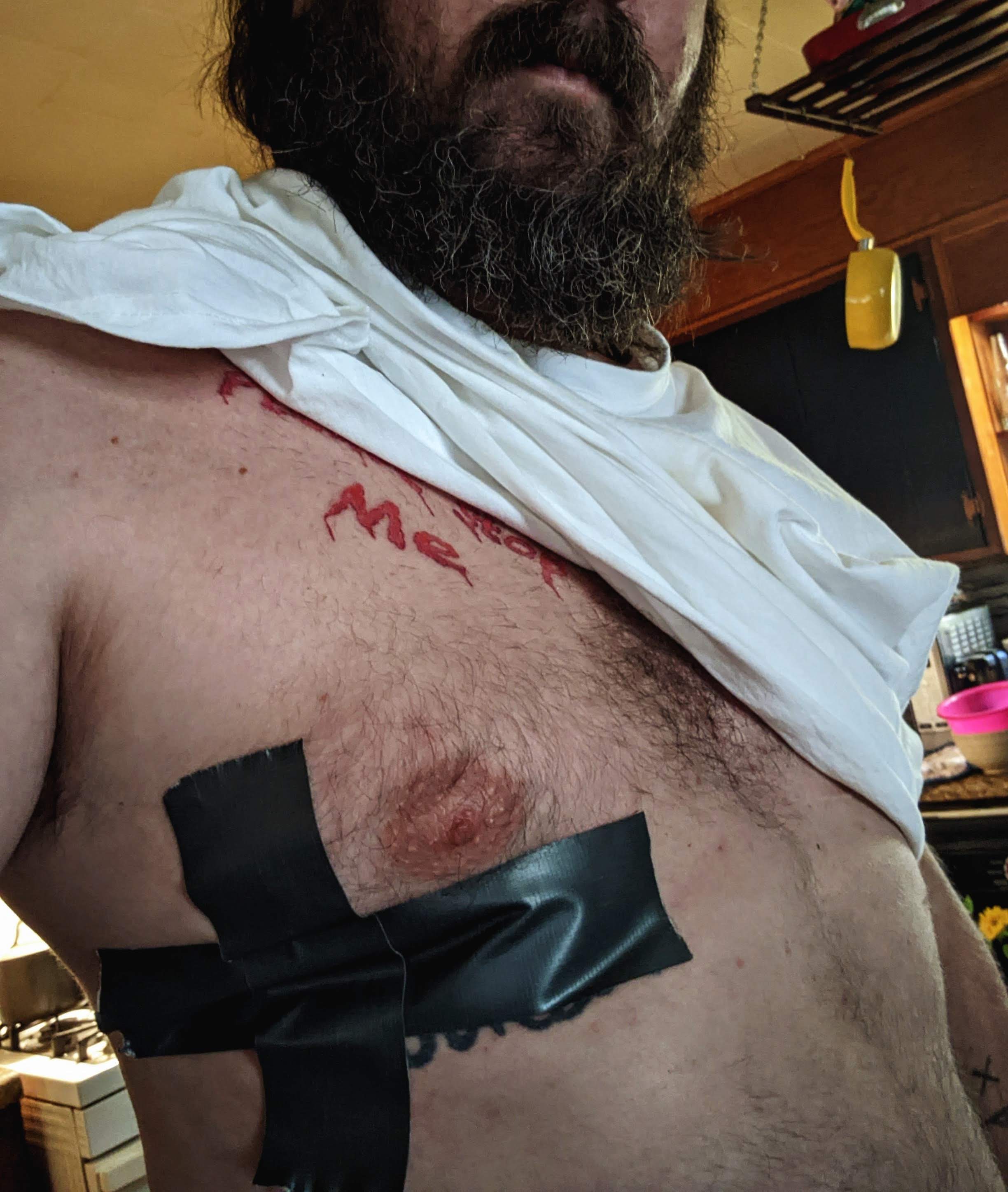 Broken rib duct tape fix
